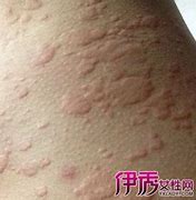 小儿荨麻疹的症状及治疗