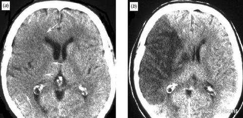 惊人的相似性，25岁与72岁的CT片