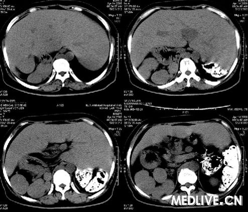 惊人的相似性，25岁与72岁的CT片