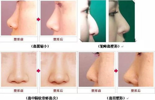 人工假体隆鼻法，塑造完美鼻型的现代魔法