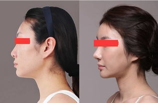 人工假体隆鼻法，塑造完美鼻型的现代魔法