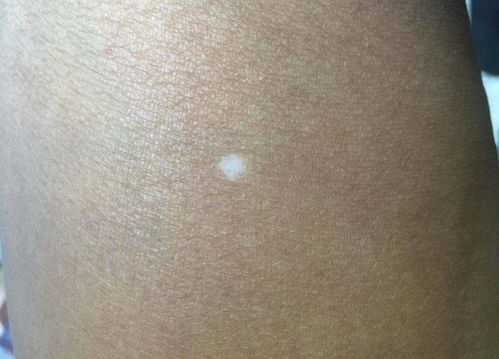 揭秘皮肤上的白色斑点，了解白癜风及其对日常生活的影响