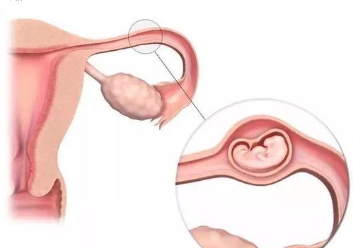 宫外孕，理解、识别与处理