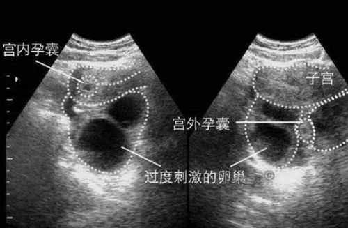 宫外孕，理解、识别与处理