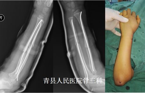 小拇指骨折，生活挑战与康复之路