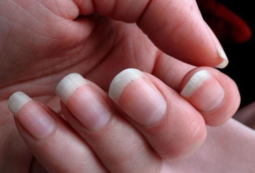 了解中指没指甲，原因、影响及应对策略