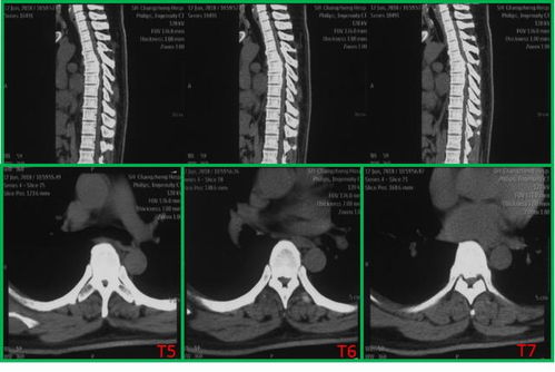 韧带断裂后的舞蹈之路，挑战与希望并存